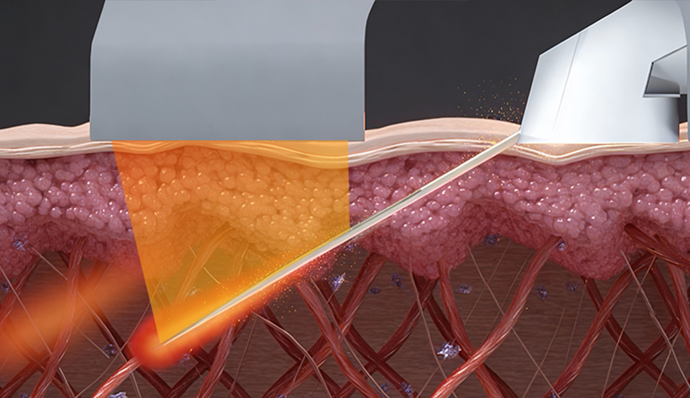 ブレッシング 真皮 RF作用図