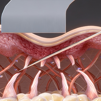 Blessing 傾斜ニードル 挿入 図解