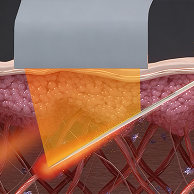 Blessing 線維剥離 図解