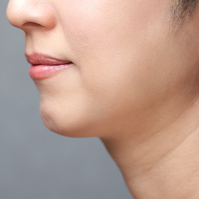 フェイスラインの悩み