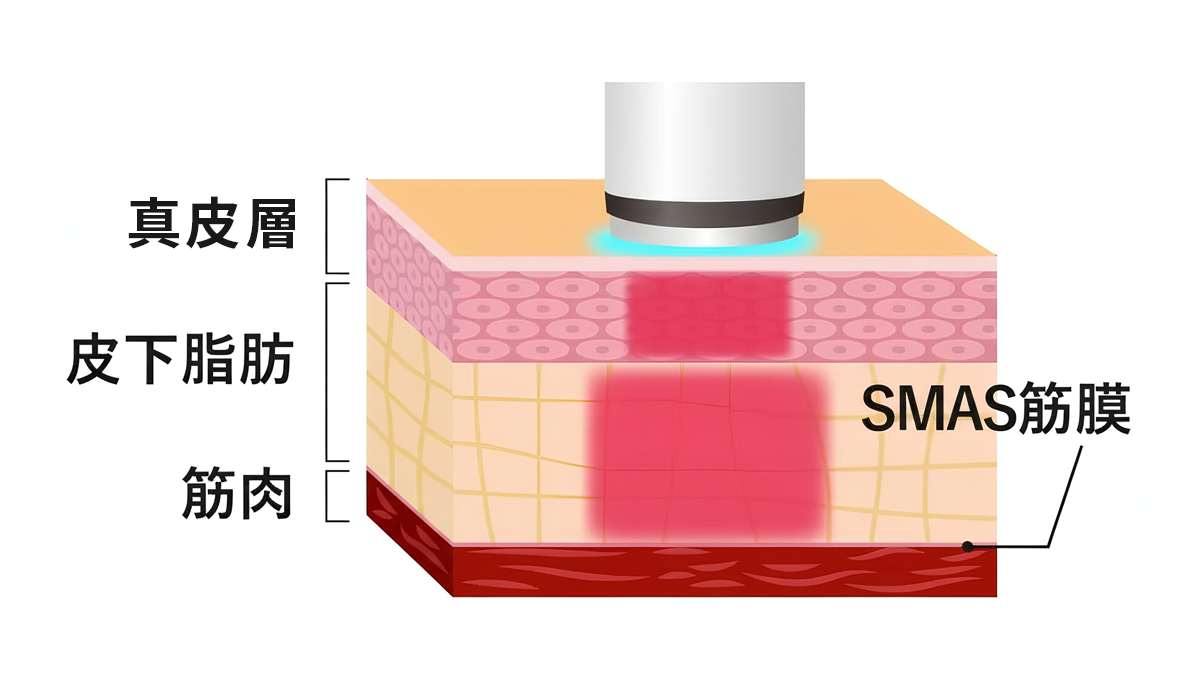 肝斑・赤ら顔image