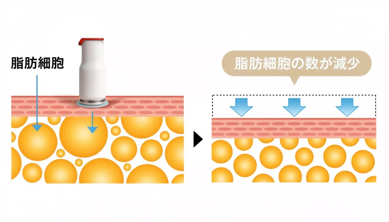 Olla Wave（オーラウェーブ） 真皮 RF作用図